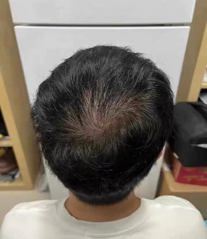 防脱洗发皂推荐精选 2026，帕思玛固发实力在线