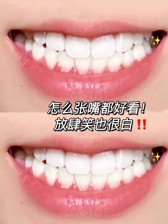 牙齿发黄怎么办？敏感牙也能美白